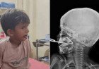 Iron Rod Pierces Boy’s Mouth | ఆడుతూ కిందపడిన బాలుడు.. నోటిలోకి చొచ్చుకెళ్లిన ఇనుప కడ్డీ