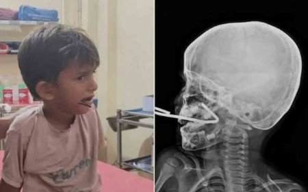 Iron Rod Pierces Boy’s Mouth | ఆడుతూ కిందపడిన బాలుడు.. నోటిలోకి చొచ్చుకెళ్లిన ఇనుప కడ్డీ